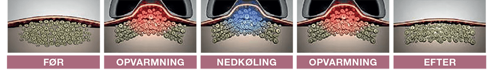WittCare_LipoContrast_process