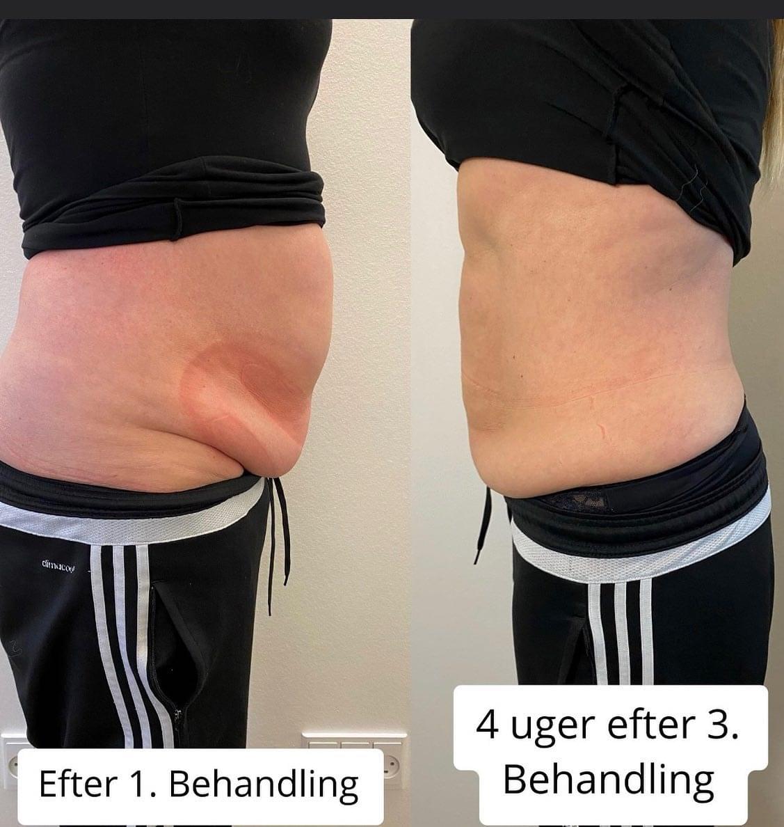 fedt-for-efter-3 Fedtfrysning resultat set fra siden