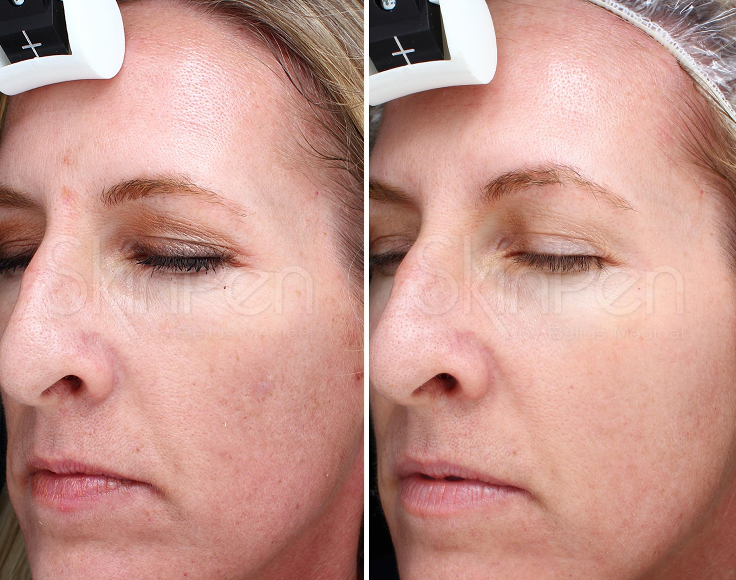 skinpen-for-efter1