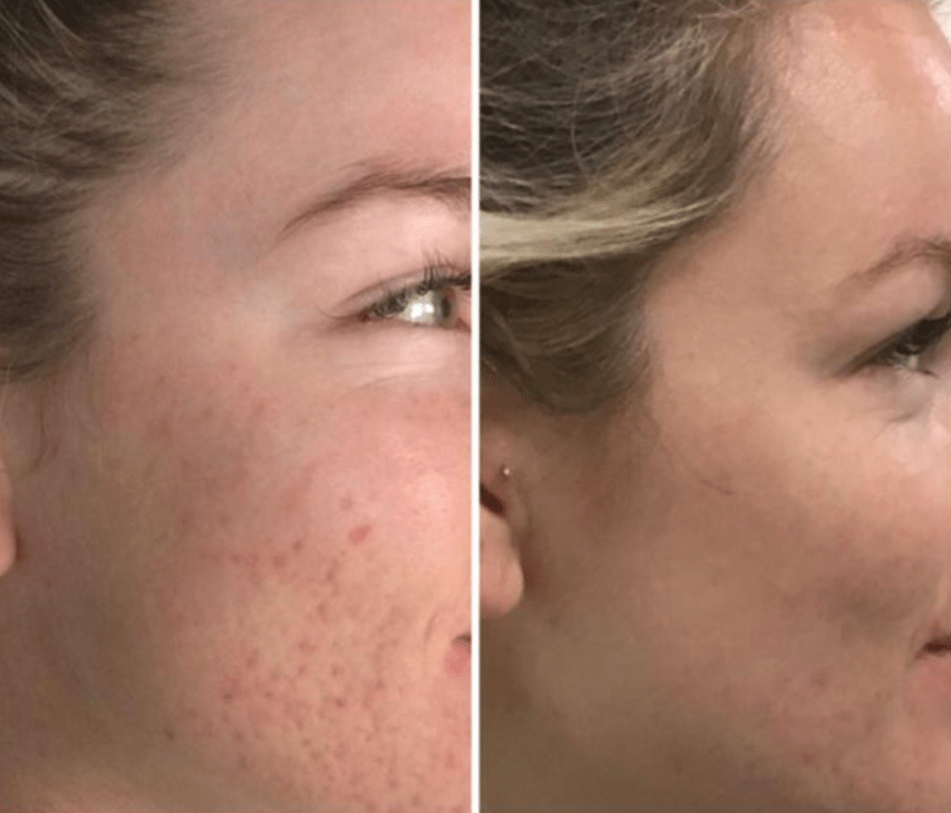 skinpen-for-efter2